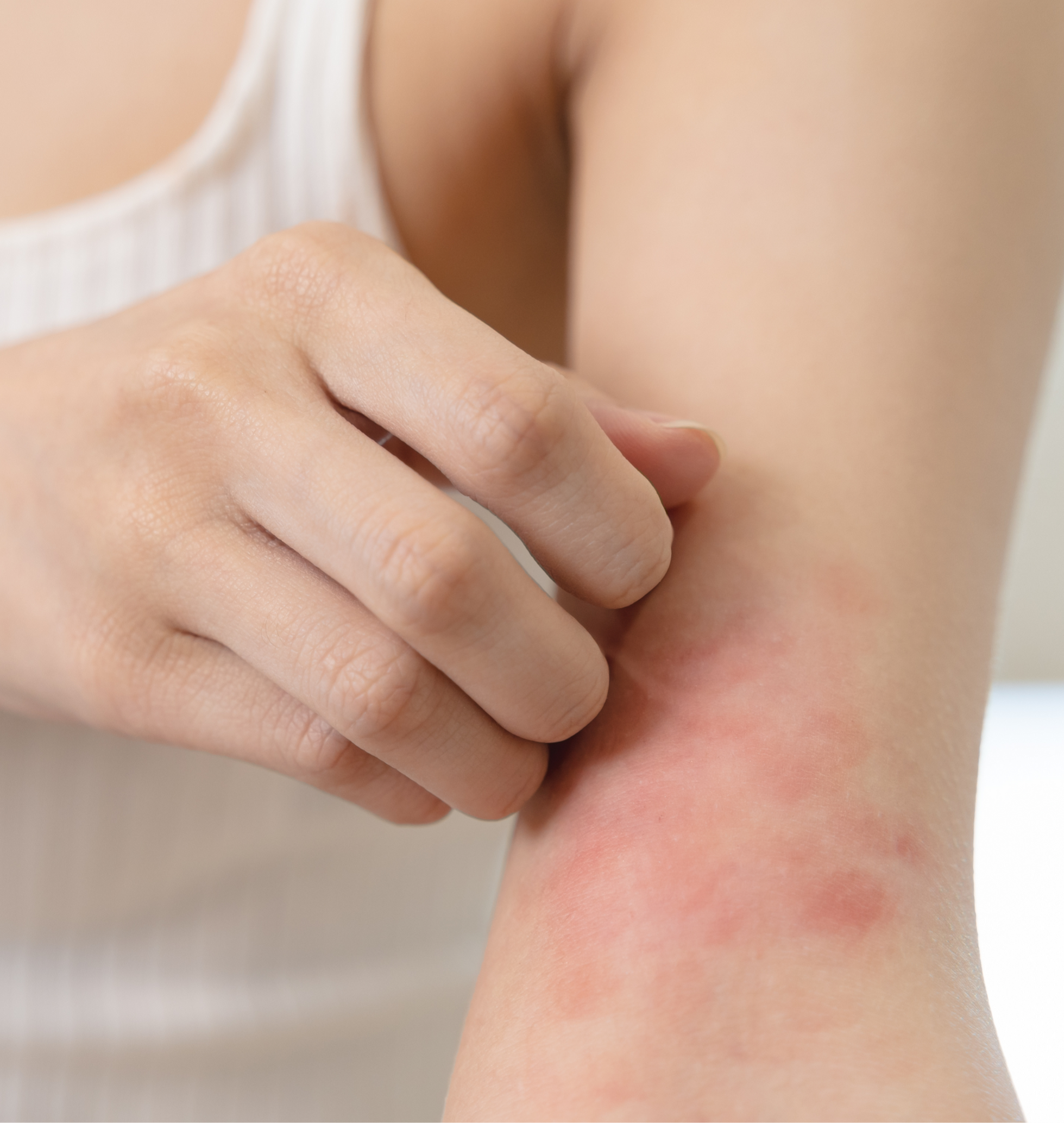 alleviare la sensazione di prurito causata dall’eczema
